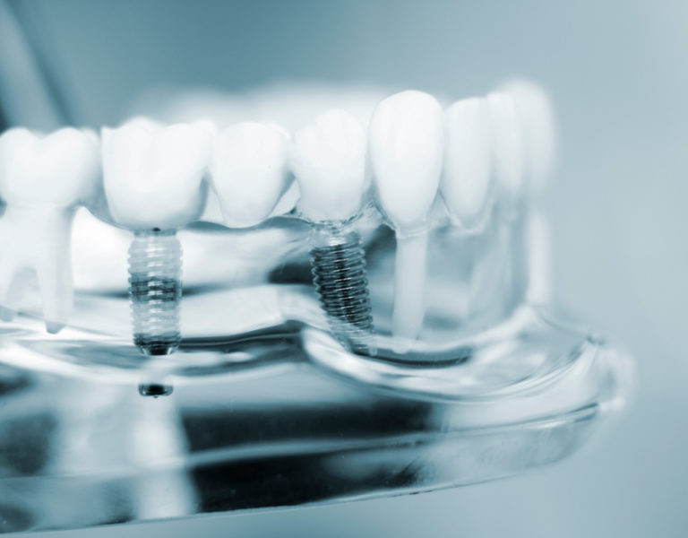 Studi Dentistici Moschioni | Impianti dentali costi